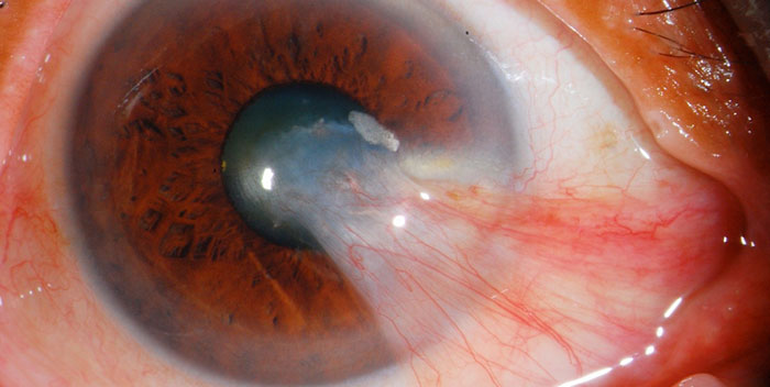 Uveitis Arten, Ursachen, Symptome, Behandlung