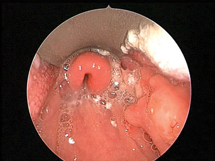 Was ist Epiglottitis Ursachen, Symptome, Behandlung, Diagnose