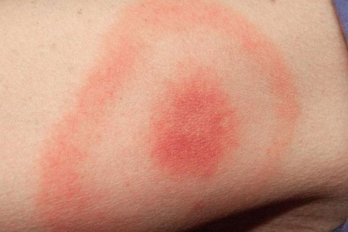 Was ist Erythema migrans mögliche Ursachen und Behandlung