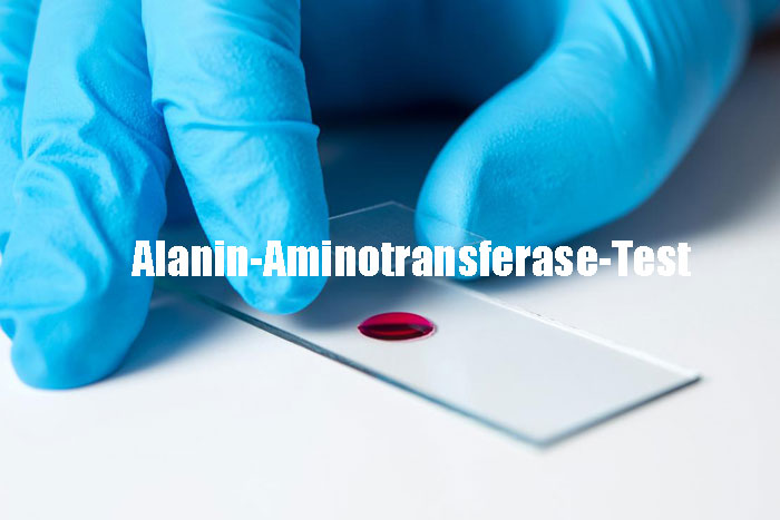 Was ist ein ALT-Test (Alanin-Aminotransferase) Alles darüber
