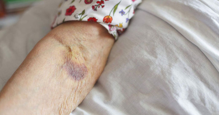 Was ist senile Purpura Ursachen und Behandlung