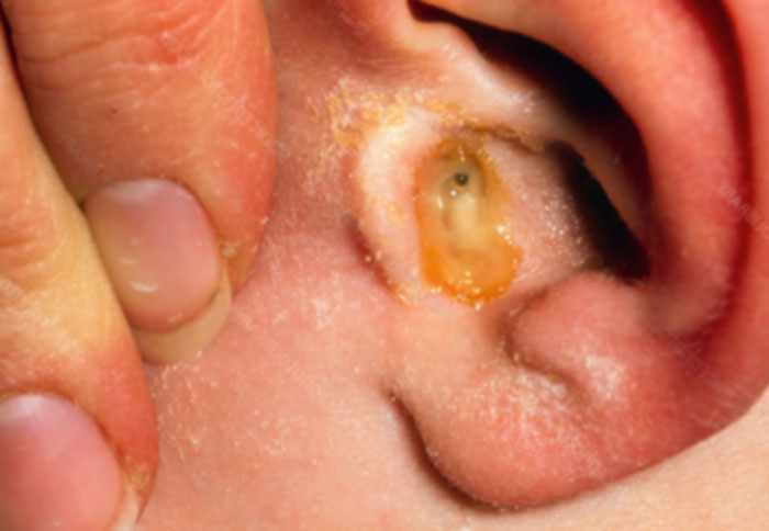 akute Otitis media Ursachen, Symptome, Diagnose, Behandlung