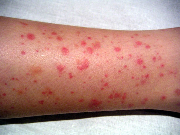 purpura Ursachen, Diagnose, Behandlung, Bilder