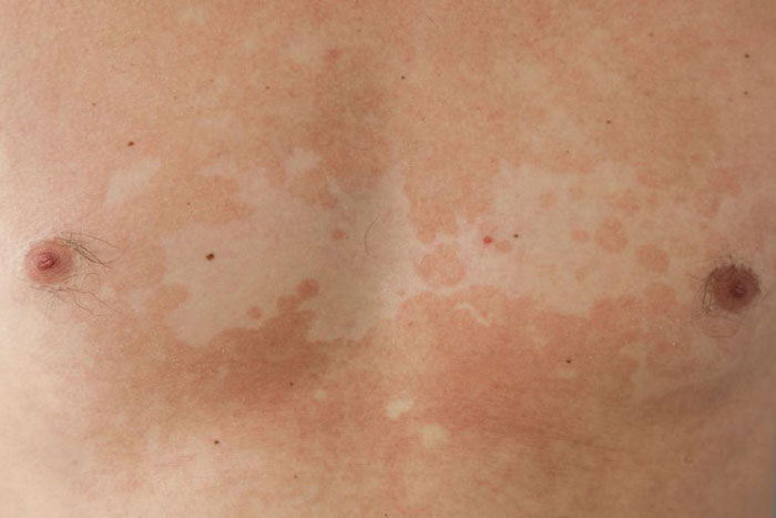 Tinea Versicolor Causes Symptoms Treatment Evolving World