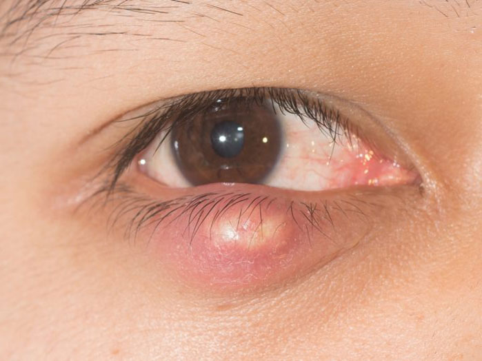 was ist eine Chalazion (Hagelkorn) ursachen und behandlung