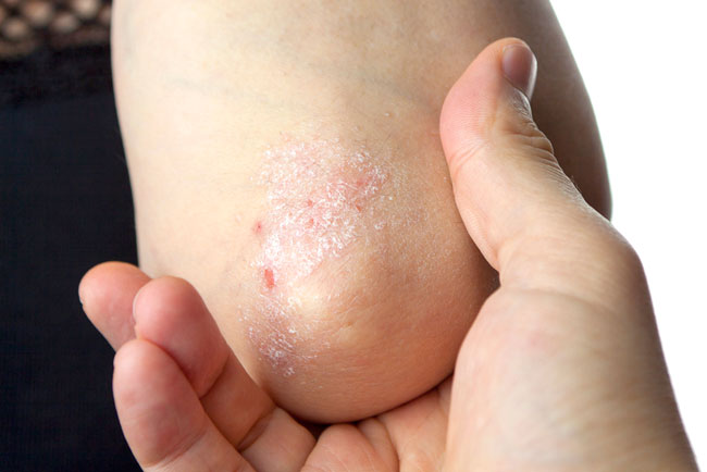 13 Fotos von der Plaque Psoriasis