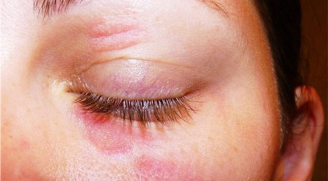 Augenlid-Dermatitis Ursachen, Behandlung, Symptome und mehr