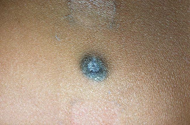 Blue Nevus Identifizierung, Entfernung und mehr