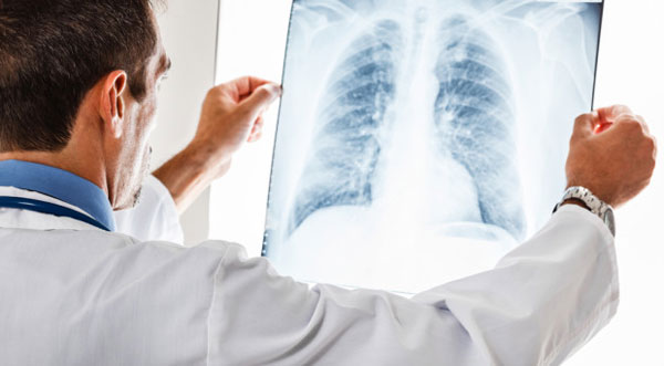 COPD und Lungenentzündung Verständnis für Ihr Risiko