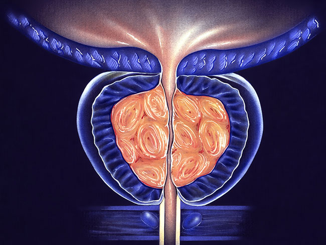 Chronische bakterielle Prostatitis Ursachen, Symptome Diagnose