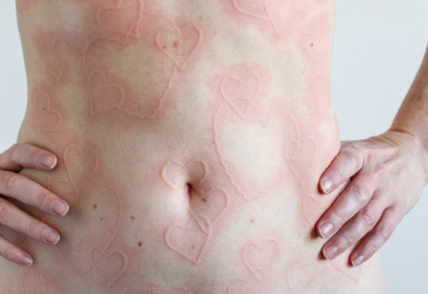 Dermatographien Symptome, Ursachen, Behandlung und mehr