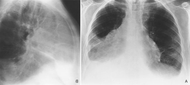 Dressler-Syndrom Ursachen, Diagnose und Behandlung