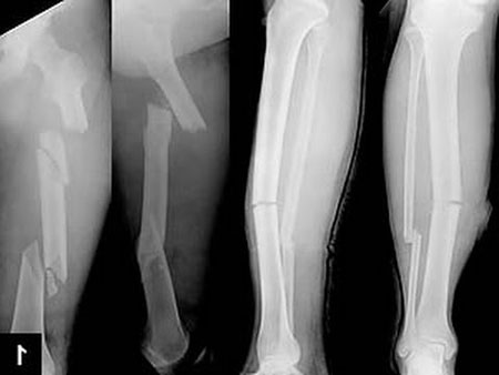 Fat Embolism Syndrom Symptome, Ursachen und Behandlung