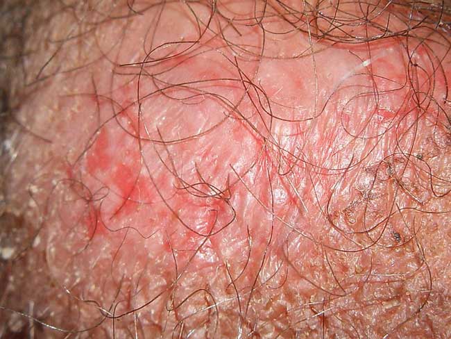 Genitale Psoriasis Symptome, Behandlung und mehr