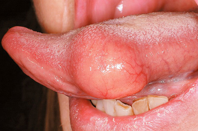 Geschwollene Zunge Ursachen, Symptome und Diagnose