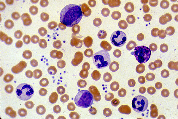 Granulozytose Ursachen, Diagnose Behandlungen