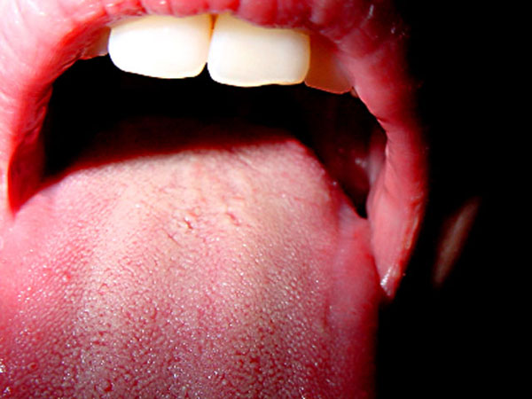 HPV im Mund Symptome, Prävention, Diagnose und mehr