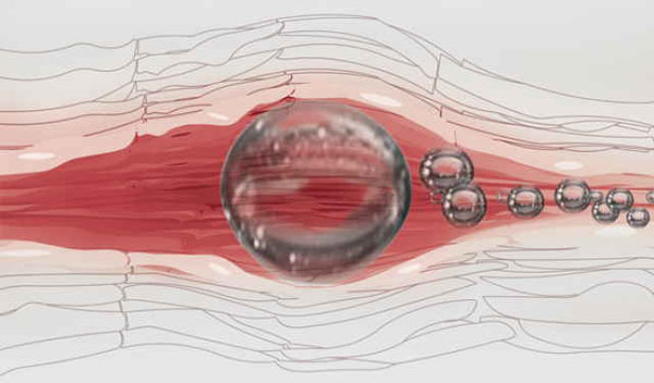 Luft-Embolie Ursachen, Symptome und Diagnose