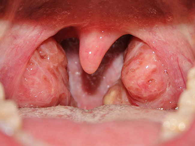 Löcher in Tonsillen Ursachen, Halsschmerzen und mehr