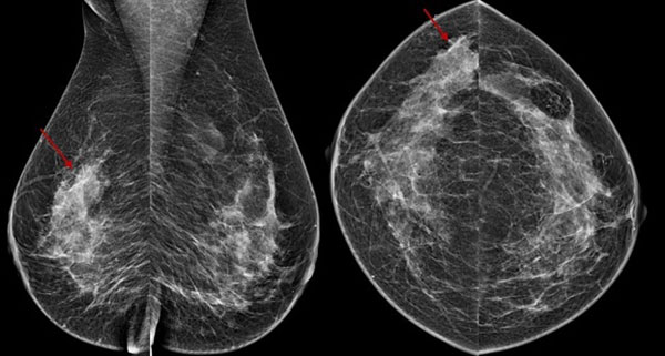 Mammographie-Bilder Ihre Ergebnisse verstehen