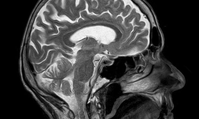 Multiple Sklerose MRI Bilder des Gehirns