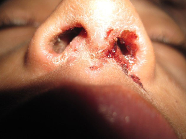 Nasale Vestibulitis Symptome und Foto, Behandlung und Komplikationen