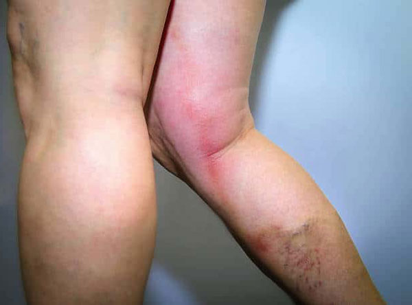 Oberflächliche Thrombophlebitis Risikofaktoren, Symptome und Diagnose