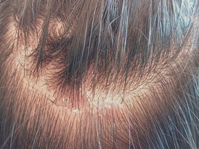 Ringwurm der Kopfhaut (Tinea Capitis) Ursachen, Symptome und Behandlung