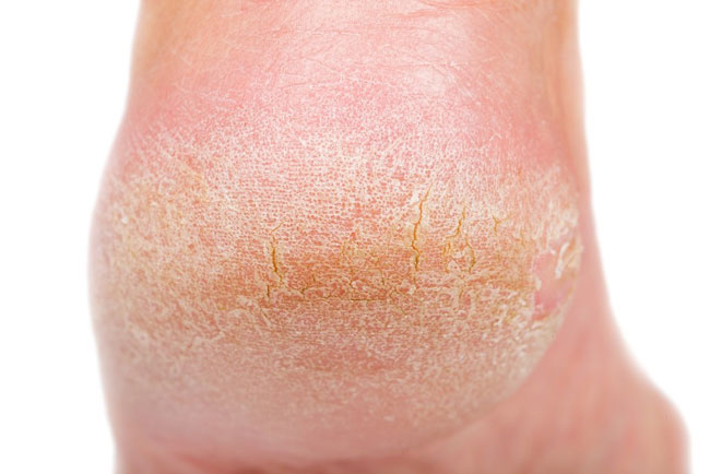 Rissige Fersen und trockene Haut an den Füßen Behandlungen und mehr
