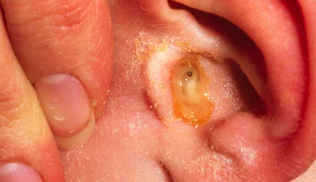 Sind Ohrinfektionen ansteckend Ursachen, Behandlung und Prävention