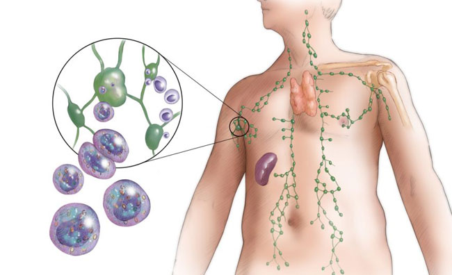 Symptome des Lymphoms Fieber, Ausschlag und mehr