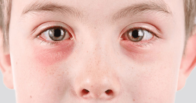 Wie lange hält das rosa Auge Viral Vs. bakterielles rosa Auge