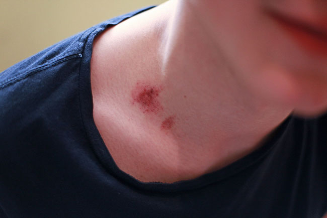 Wie man sich von einem Hickey befreit 10 Wege