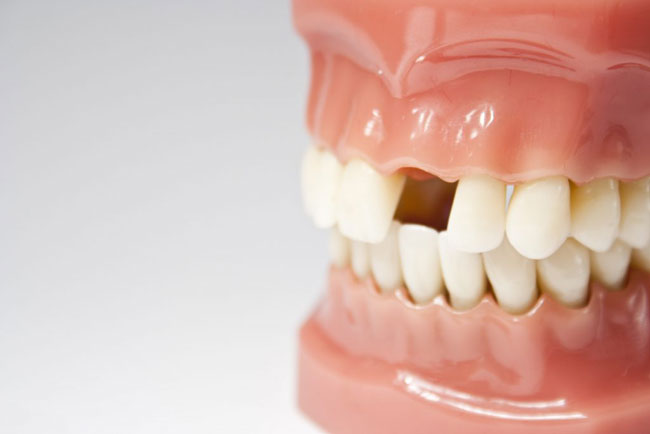 Wie viele Zähne haben Erwachsene Oben, unten und Babys