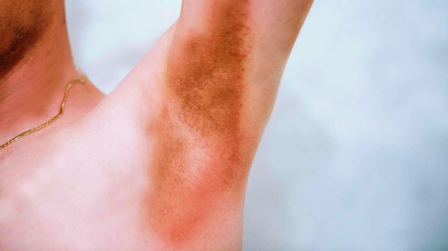 Inverse Psoriasis: Bilder, Ursachen und Behandlungen, Symptome